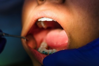 Campanha Novembro Vermelho reforça importância do diagnóstico precoce do câncer de boca